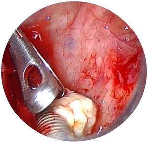 Dental implant view by trocar using 0° endoscope.