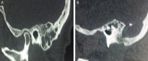 (A) Temporal bone CT scan: thickened mucosa within the mastoid air cells. (B) Presence of an expansive osteolytic temporal bone lesion; note the destruction of mastoid apex.