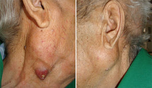 Bilateral swelling of the parotid glands. The right parotid gland shows a small, painless ulcer with continuous pus discharge.