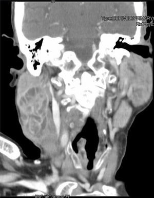 CT coronal section showing multiple trabecular zones with cystic and necrotic areas, seen better on the right side in this image.