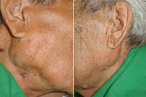 Pictures obtained after treatment was completed (10 month). The parotid gland swelling reduced on both sides and the ulcerative lesion on the right side healed.