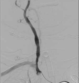 Left carotid artery stent in a patient who suffer a carotid blowout syndrome.