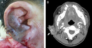 Gross findings and temporal bone computed tomographic angiography findings on the ear of a 60 year-old man, as recorded in the emergency room: (A) the patient presented with a swollen ear and spontaneous massive bleeding; (B) temporal bone computed tomographic angiography revealed a right-side, auricular vascular tangled lesion (white arrow).