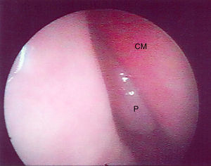 Image of endoscopy of a grade I polyp in the right nasal cavity of patient no. 12 (P, polyp; CM, middle turbinate).