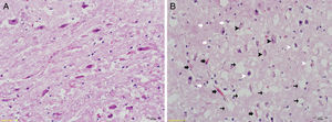 Histomorphological examination H&E staining (40×); (A) control group: tissue integrity, general appearance of cells is natural, no changes in neuron size. (B) RF-EMF group: degeneration of neurons in the ventral cochlear nucleus, degradation (black arrowheads), in addition to some decrease in neuron size, shrunken pyknotic cells (white arrowheads). Increased numbers of glial cells (white arrows) and areas with increased vascularization (black arrows). Intense vacuolization in tissue (thin black arrows) and edematous areas.