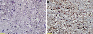 TUNEL staining results; (A) control group; (B) study group: apoptotic cells (black arrowheads), pyknotic neurons (black arrows), diffuse vacuolated areas (white arrowheads).