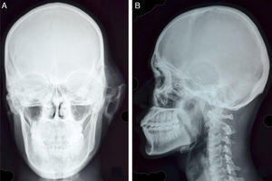 (A) Skull PA view reveals swelling of osseus origin overlying left temporal bone with thinned out cortex and interlacing septae. There is associated breach in the cortex of left greater wing of sphenoid and non-visualization of left petrous bone. Soft tissue swelling and lateral displacement of left pinna is seen. (B) Lytic, geographic lesion in left temporal bone with, narrow zone of transition and irregular, sclerotic margins is well appreciated on the lateral view.