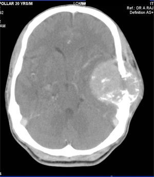 On soft tissue window settings, the lesion shows enhancing soft tissue with a large intracranial component causing mass effect and mild white matter edema in the adjacent temporal lobe and a small superficial component in the scalp. A few small specks of matrix mineralization are noted as well.
