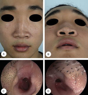 Preoperative profiles and endoscopic findings. Frontal (A) and basal (B) views show linear scars in the nasal dorsum and collapse of the left nasal alar cartilage. Nasal endoscopy shows vestibular stenosis obscuring about 70% and 90% of the right (C) and left (D) nasal vestibule, respectively.