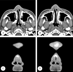 Preoperative facial computed tomograms. Axial (A, B) and coronal (C, D) images show soft tissue synechiae within the both nasal vestibule causing a vestibular stenosis. Nasal septum deviation to the left side is noted.