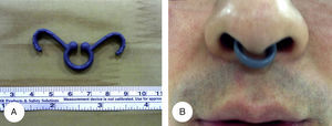 Nasal stent. (A) A wing-shaped stent has the inherent spring effect. (B) The stent placement provides a gentle pressure to the lateral nasal wall and septum, thus creating a tunnel in between.