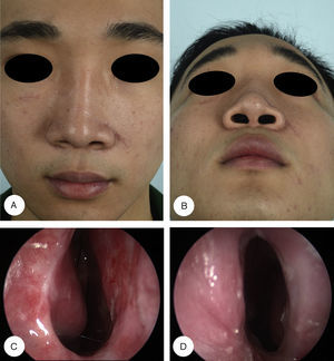 Postoperative profiles and endoscopic findings. Frontal (A) and basal (B) views show excellent cosmetic outcome. Nasal endoscopy at postoperative six months shows the right (C) and left (D) nasal vestibules are patent, with no evidence of restenosis.