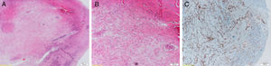 (A–C) Microscopic findings of the specimen showed that many irregular vascular structures range from capillaries and sinusoids surrounded by a fibrous stroma.