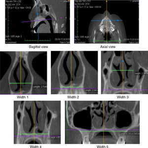 Sagittal and axial planes used for protocol for the reformatted coronal planes (Widths 1–5). Widths 1 and 2 – head of the inferior turbinate; Widths 3 and 4 – head of the middle turbinate; Width 5 – maxillary bone.