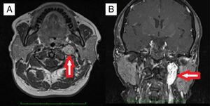 A case of left sided TJP with typical salt and pepper appearance; meaning areas of high and low intensity on MRI. (A) An axial section of T1 weighted sequences. (B) A coronal section of T1 weighted fat suppressed sequences.