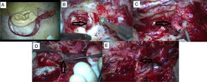 A case of TJP presented with HB grade 5 facial nerve palsy and undergone gross total tumor excision via IFTA-A approach after preoperative embolization. (A) Post-auricular incision with cervical extension. (B) Tumor extension is seen in hypotympanium during mastoidectomy. (C) Facial nerve is sacrificed which is invaded by tumor at stylomastoid foramen region. (D) Tumor originating from jugular bulbus. (E) CN 7–12 anastomosis.