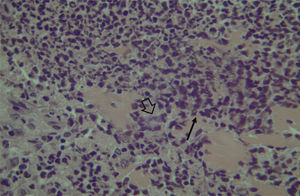 Mucosa of the maxillary sinus showing intense lymphocytic infiltrate (narrow arrow) and glandular destruction (wide arrow) – optical microscopy, HE staining, 200×.