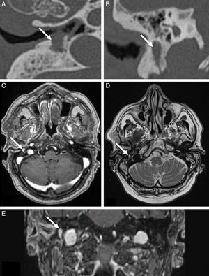 Radiological examination of chorda tympani schwannoma with associated MOE. (A) Axial CT scan demonstrating well-defined soft tissue lesion. (B) Reconstructed coronal CT image demonstrating above soft tissue lesion caused an osteolytic erosion of the mastoid along the vertical segment of the facial nerve. (C) T1 with gadolinium MRI image in axial projection: the chorda tympani tumor exhibits a homogenous hyper-enhancement. (D) The MRI axial T2-weighed image in axial projection shows the hyperintense schwannoma. (E) T1 with gadolinium MRI image in coronal projection: the chorda tympani tumor exhibits a homogenous hyper-enhancement. MOE, malignant otitis externa; CT, computed tomography; MRI, magnetic resonance imaging.