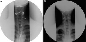 Comparison of the pre- and postoperative esophagography findings (Case 1). (A) Preoperative esophagography showing a fistula arising from the left pyriform fossa. (B) Postoperative esophagography showing no fistula.