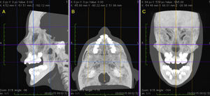 Final repositioning of the head with the sagittal (A), axial (B) and coronal (C) slices duly oriented in relation to the Frankfurt plane and the midsagittal plane.
