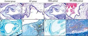 Representative photomicrographs of cartilage histology in the control, HBO2, RT and RT+HBO2 groups. Control group: (A) general appearance of H&E (×20); (B) Immunohistochemical LCA (×20). RT group: (C) H&E (×100) black arrow squamous metaplasia – blue arrow columnar epithelium. (D) Immunohistochemical LCA (×40) yellow arrow LCA positive lymphocytes. HBO2 group: (E) H&E (×20) general appearance; (F) Immunohistochemical LCA (×20). RT+HBO2 group: (G) H&E (×100) black arrows quamous metaplasia – blue arrow columnar epithelium; (H) Immunohistochemical LCA (×100) yellow arrow LCA positive lymphocytes.
