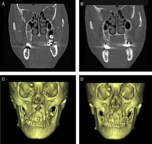 CT and 3D reconstruction images of bone removal method. (A and C) Before operation. (B and D) Images postoperatively shows normal shape.