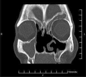 CT scan of the sinuses – 12 months after surgery, coronal plane.