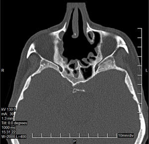 CT scan of the sinuses – 12 months after surgery, axial plane.