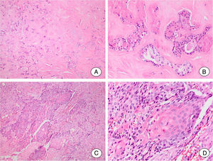 Squamous cell carcinoma ex pleomorphic adenoma. (A, B) Residual pleomorphic adenoma. (A) Pleomorphic adenoma area shows extensive hyalinization of the stroma. (B) Few ductal structures lined by cells without atypical features can be seen. (C, D) Carcinomatous component. (C) A frankly invasive squamous cell carcinoma is the malignant component of the tumor. (D) Detail of the malignant component showing islands formed by cells with squamous differentiation.