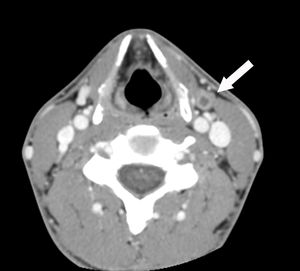 Axial computed tomography scan of the neck shows an 8.2cm elongated rim-enhancing cystic lesion (arrow) along the left anterior neck.