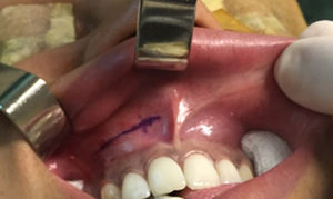 Marking of the incision in the upper gingival-labial groove bottom.