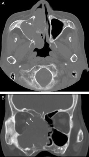 (A) Axial CT scan shows the soft tissue mass in the paranasal sinus and nasal cavity. Bone destruction of the medial wall of maxillary sinus is apparent and the margin is obscure (white arrow in A). Patchy calcification is found in the lesion (black arrow in A). (B) Coronal CT scan shows main body of soft-tissue mass is located in ethmoid sinus and nasal cavity and it damaged bone of right orbit with compression of the medial rectus (white arrow in B). The wall of the right ethmoidal sinus, right maxillary sinus and right frontal sinus were damaged.