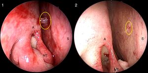 Right nasal cavity. S-point (yellow circle) before (1) and after (2) the use of cotton pledgets with topical decongestant. After vasoconstriction, the S-point vascular pedicle practically disappears (A, axilla of the middle turbinate; MT, middle turbinate; S, nasal septum).