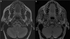 (a) T2-weighted axial sequence shows heterogeneous hyper signal intensity, due to the presence of areas of marked low signal intensity. (b) T1-weighted FAT-SAT axial sequence after medium contrast intake shows an irregular enhancement, since the medium contrast uptake was absent in the central and in the cystic areas, but it was higher in the solid peripheral component of the tumor.