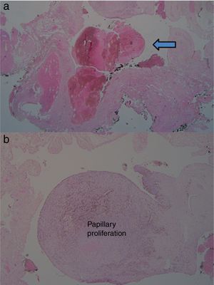 (a) Microscopic examination showed an organizing thrombus (arrow). (b) Microscopic examination showed intravascular papillary proliferation lying of endothelial cells.