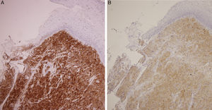 (A) Positive S-100 immunostain. (B) Positive neuron-specific enolase immunohistochemical staining denoted its neuroectodermal origin.