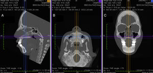 Multiplanar images (A) sagittal, (B) axial and (C) coronal, with contrast settings optimized for viewing the soft tissues of the nose.
