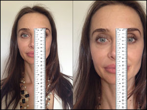 Example of the major problem of using absolute measures in photogrammetry. The same patient, therefore the same nose, but photos in different sizes, creating the illusion that the nose on the photo on the right is longer. This problem can be eliminated using ratios and angles between the primary measurements. Model: Fabiana Maros.