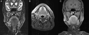 The magnetic resonance images of the lobulated mass of right submandibular region (black arrows) in T1A sections (A), and in T2 fat suppressed sections (B and C).