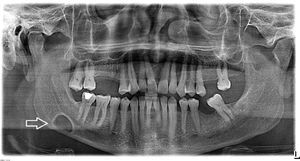 Oval shaped, well-bordered cystic lesion (white arrow) between second molar and the mandibular angle, slightly above the inferior mandibular line in panoramic radiograph.