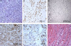 Histopathology and immunohistochemical stain, histiocytoid eccrine carcinoma: (A), cords and small nests of histiocytoid cells; tumor cells are positive for cytokeratins (B) and negative for synaptophysin (C), tumor cells are S-100 positive (D), some cells are GFAP positive (E), and cords of histiocytoid cells are separating muscle fibers (F).