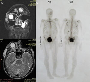 Magnetic resonance imaging scan: left orbit after exenteration without pathologic enhancement, mucus fluid in left maxillary sinus-frontal and plain projection (A and B). Bone scintigraphy, multiple intense enhancement in left orbit, and bony skeleton due to metabolic and postoperative changes (C).