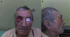 Patient two years after left orbit exenteration and radiotherapy; the second tumor is infiltrating the right periorbital skin and eyelids, frontal and lateral view (A and B).