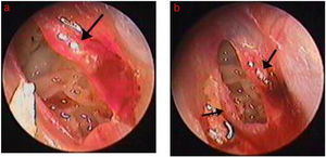 The healing process of perforation after Gelfoam patching: (A) 3 days after Gelfoam patching treatment; (B) 4 days after Gelfoam patching treatment. Black arrows indicate granulation tissue, edema, and exudate at the margin.