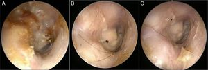 Right ear: (A) pre-operative period; (B) post-operative period; (C) epithelial migration pattern on the posterior superior direction.