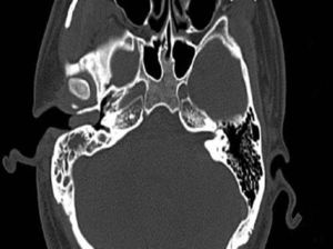 Axial CT scan before surgery showing a well-circumscribed strip of solid mass in the right external auditory canal without bony erosion and a medium-density area in the tympanic antrum.