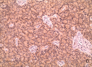 Immunohistochemistry for neuron-specific enolase (NSE) (magnification 100×).