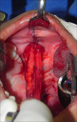 Intraoral photograph showing the buccinator myomucosal flap and synthesis of the donor area without tension (“F”, buccinator flap).