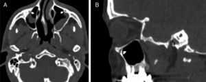 (A) Axial paranasal sinus CT image showing right-sided infraorbital canal Type 1 within the maxillary bony roof and left-sided infraorbital canal Type 2 partially protruding into maxillary sinus (thick arrows). (B) Right parasagittal image showing infraorbital canal Type 1 (arrowhead).