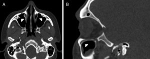 (A) Axial paranasal sinus CT image showing bilateral infraorbital canal Type 2 partially protruding into the maxillary sinus (arrowheads). (B) Right parasagittal image showing infraorbital canal Type 2 (arrowhead).